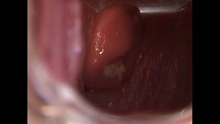 Avy Atvērt Incītis ar Speculum